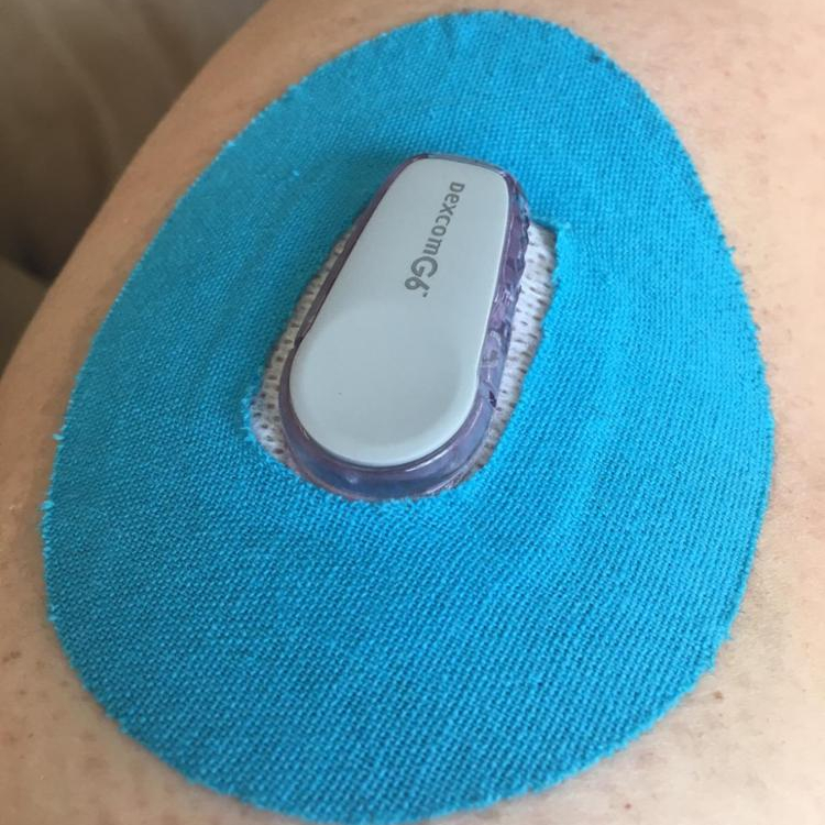 Dexcom là gì?